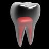 single visit root canals