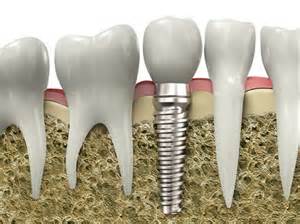 dental implant